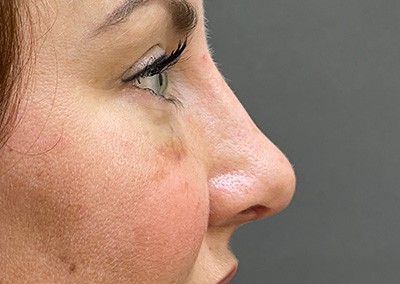 After Image: Rhinoplasty - right-side