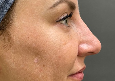 Before Image: Rhinoplasty - right-side