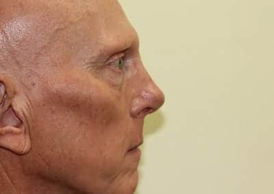 After Image: Rhinoplasty - right-side