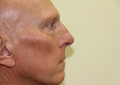 Before Image: Rhinoplasty - right-side