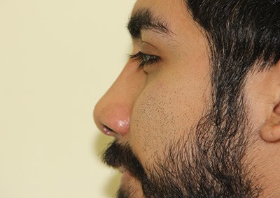 After Image: Rhinoplasty - left-side