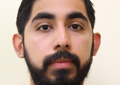 Before Image: Rhinoplasty - front