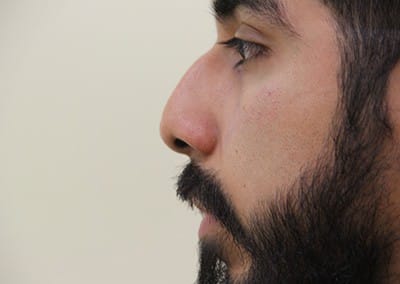 Before Image: Rhinoplasty - left-side