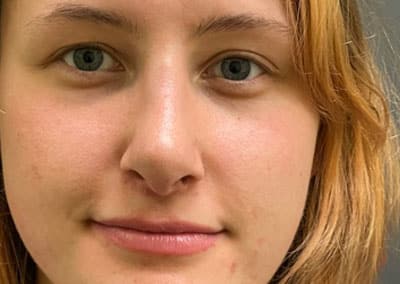 After Image: Rhinoplasty - front