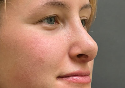 After Image: Rhinoplasty - right-front-oblique