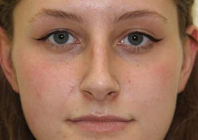 Before Image: Rhinoplasty - front