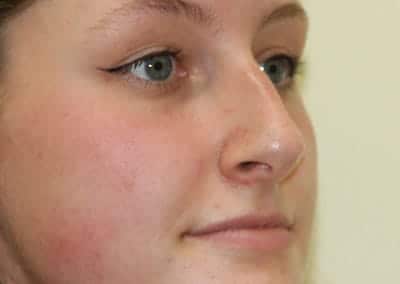 Before Image: Rhinoplasty - right-front-oblique