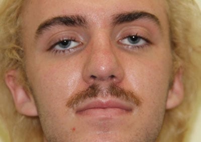 After Image: Rhinoplasty - front