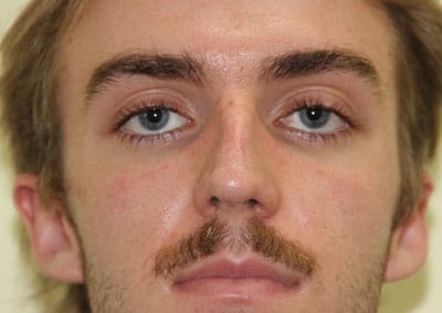 Before Image: Rhinoplasty - front