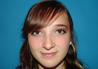 After Image: Rhinoplasty - front