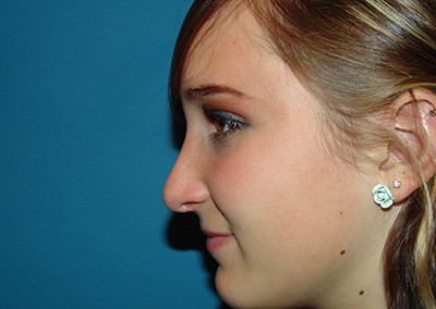 After Image: Rhinoplasty - left-side