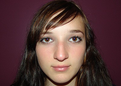 Before Image: Rhinoplasty - front