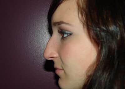 Before Image: Rhinoplasty - left-side
