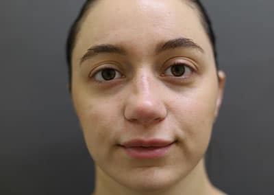 After Image: Rhinoplasty - front