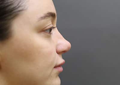 After Image: Rhinoplasty - front