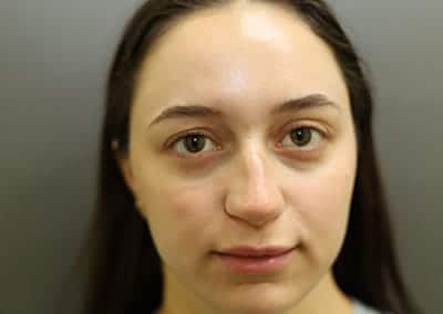 Before Image: Rhinoplasty - front
