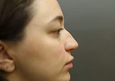 Before Image: Rhinoplasty - front