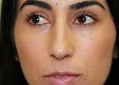 Before Image: Rhinoplasty - front