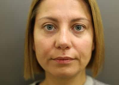 After Image: Rhinoplasty - front