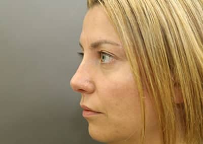 After Image: Rhinoplasty - left-side