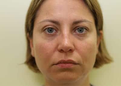 Before Image: Rhinoplasty - front