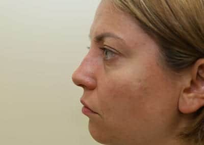 Before Image: Rhinoplasty - left-side