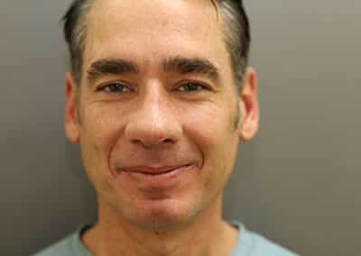 After Image: Rhinoplasty - front