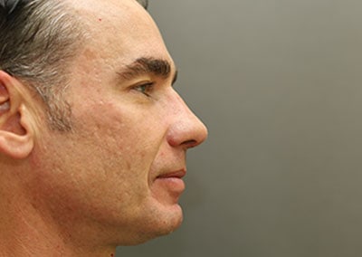 After Image: Rhinoplasty - right-side