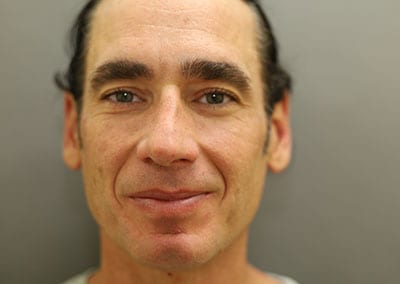 Before Image: Rhinoplasty - front