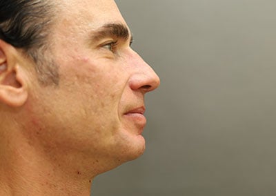 Before Image: Rhinoplasty - right-side