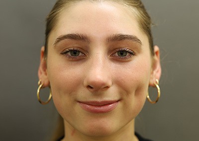 After Image: Rhinoplasty - front