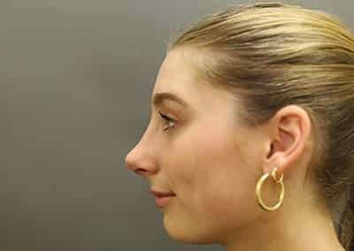 After Image: Rhinoplasty - front