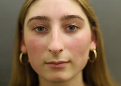 Before Image: Rhinoplasty - front