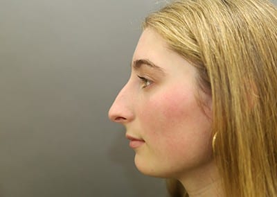 Before Image: Rhinoplasty - front