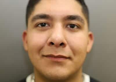 After Image: Rhinoplasty - front