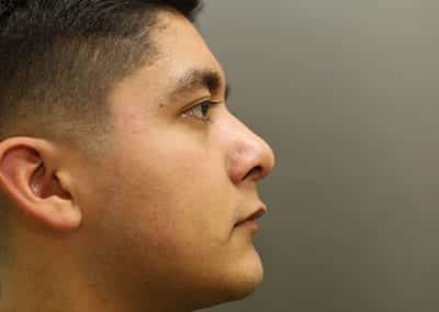 After Image: Rhinoplasty - right-side