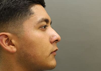 Before Image: Rhinoplasty - right-side