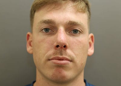 After Image: Rhinoplasty - front