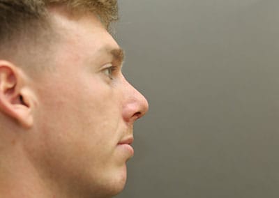 After Image: Rhinoplasty - right-side