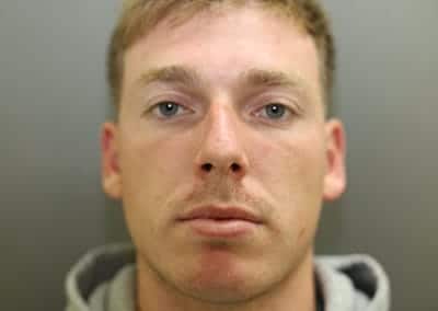 Before Image: Rhinoplasty - front