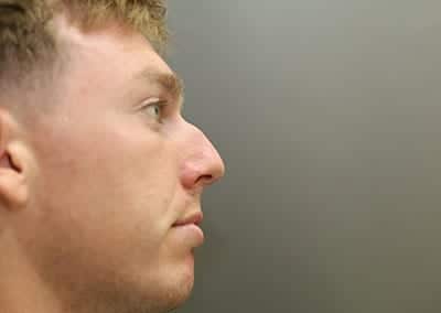 Before Image: Rhinoplasty - right-side