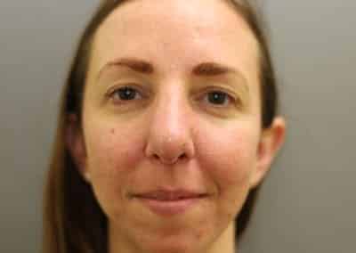 After Image: Rhinoplasty - front