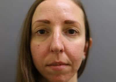 Before Image: Rhinoplasty - front