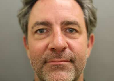 After Image: Rhinoplasty - front