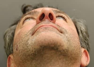 After Image: Rhinoplasty - front