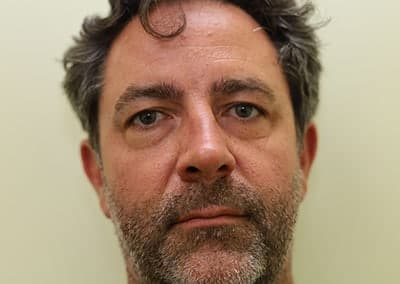 Before Image: Rhinoplasty - front