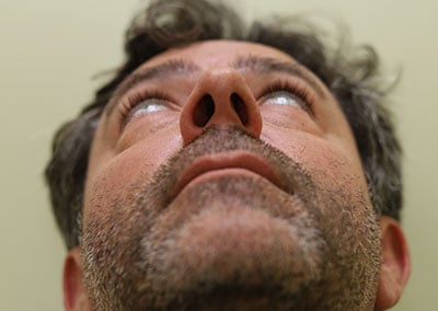 Before Image: Rhinoplasty - front