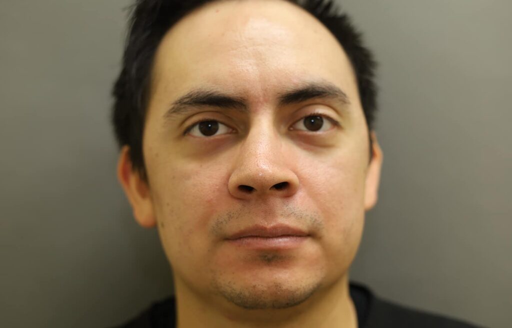 Before Image: Rhinoplasty - front