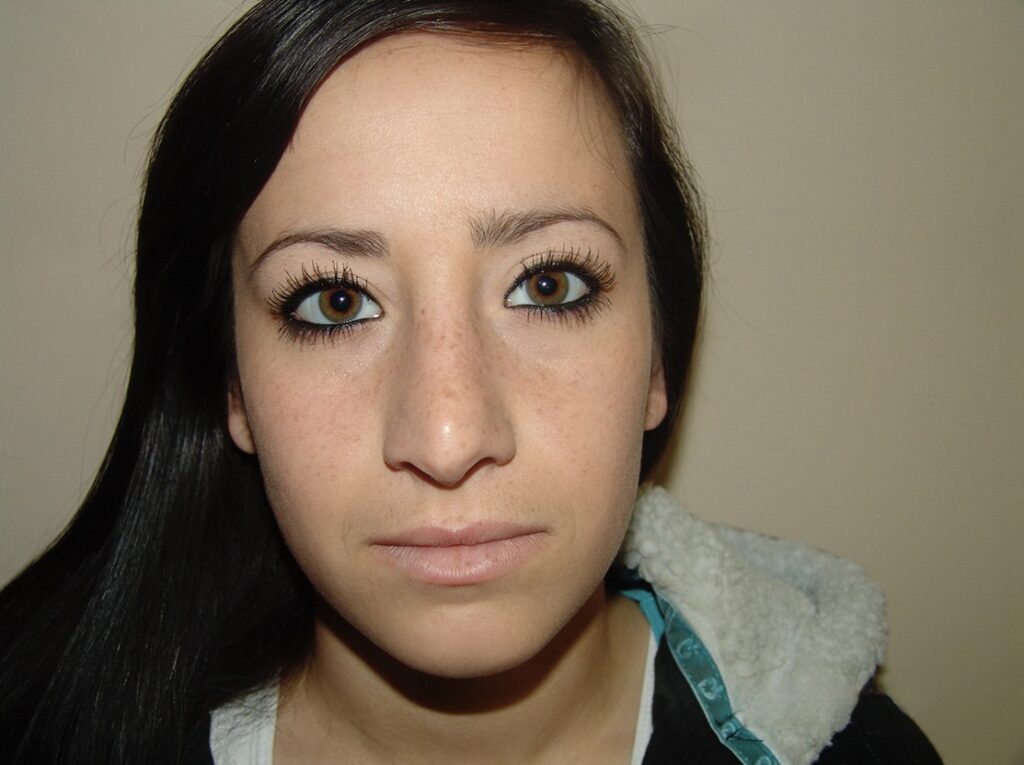 After Image: Rhinoplasty - front