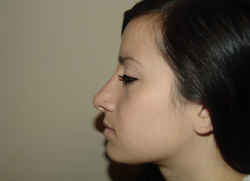 After Image: Rhinoplasty - front